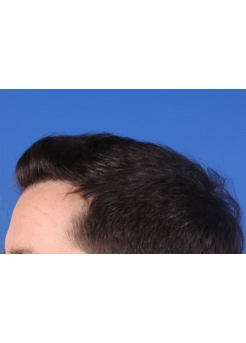 After Hair Transplant&nbsp;Hairlines